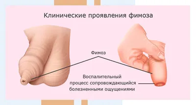 Обрезание крайней плоти у мужчин. Операция циркумцизия.