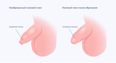 Обрезание крайней плоти | Медицинский центр Здоровый ребенок