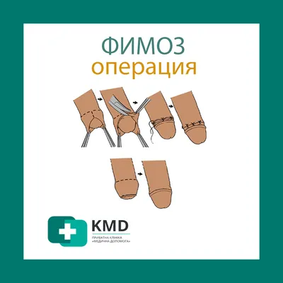 Обрезание у детей - IMS Clinic