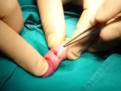 Обрезание крайней плоти, лазерное обрезание у мужчин без крови и боли |  Хирург Щевцов А.Н. - YouTube