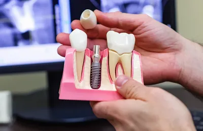 Протезирование зубов - Клиника Сатори