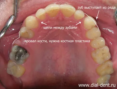 Ортопедия (протезирование) в клинике Доктора Пешковой - Стоматологическая  клиника доктора Пешковой, стоматология в Отрадном, функциональная  стоматология