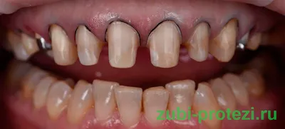 Зуб после обточки: современные методы восстановления, виды протезов