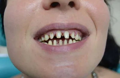 Можно ли ставить виниры на кривые зубы
