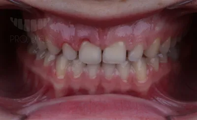 Типы и виды виниров, их основные отличия, установка в стоматологии
