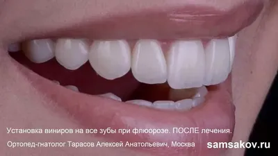 Виниры на зубы, цена в Москве, установка на передние зубы