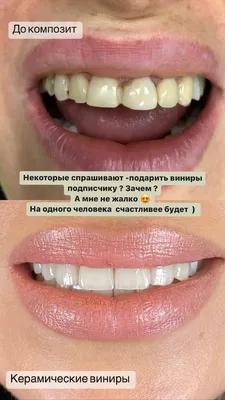 Стоимость установки виниров на зубы в Туле, цены от 14000 рублей.
