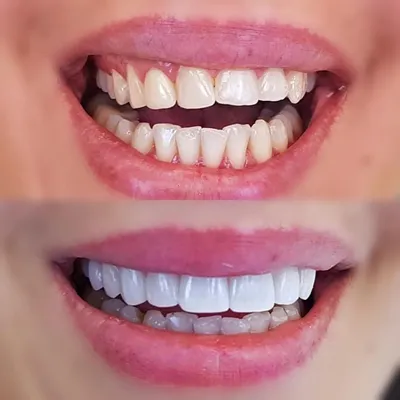 Как ставят виниры на зубы – как устанавливаются прямым и непрямым методом |  «Фактор улыбки»