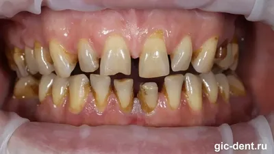 Красивая и естественная улыбка после протезирования зубов керамикой