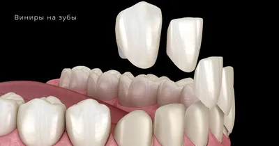 Виниры на зубы плюсы и минусы - стоматологическая клиника на Отрадном |  Ласка