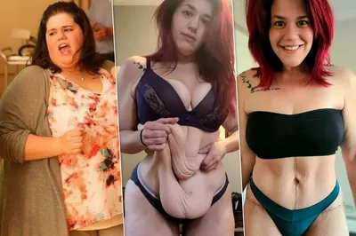 Девушке, похудевшей на 141 кг, врачи удалили лишнюю кожу
