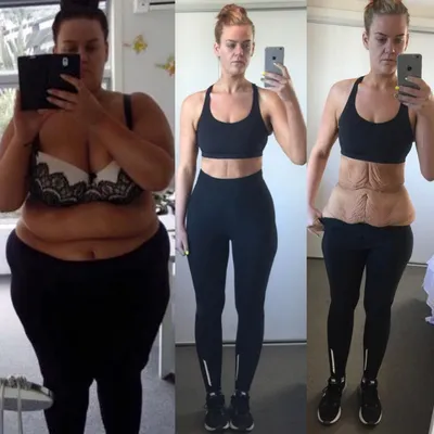 Шок-контент: как выглядят тела женщин, похудевших на 50, 100 и даже 150 кг