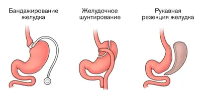 Девушка показала отрицательную сторону экстремальной потери веса