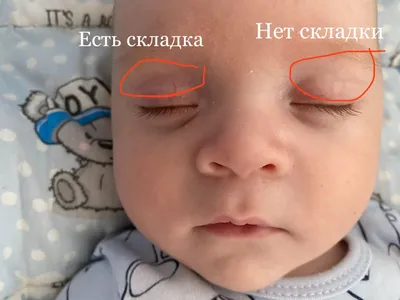 Ответы Mail.ru: Один глаз меньше другого (щель глазная) перенесены  конъктивиты