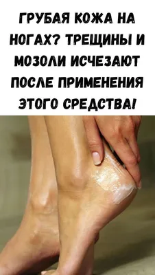 сухая кожа и кожа в ногах. нога дерматита Стоковое Фото - изображение  насчитывающей хроническо, псориаз: 232414020