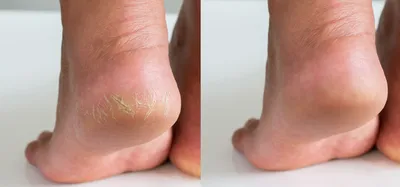 Шелушение кожи между пальцами ног: причины и способы лечения