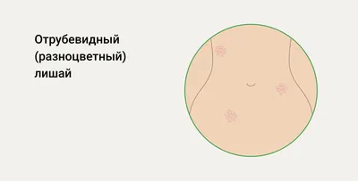 Отрубевидный лишай - причины появления, симптомы заболевания, диагностика и  способы лечения