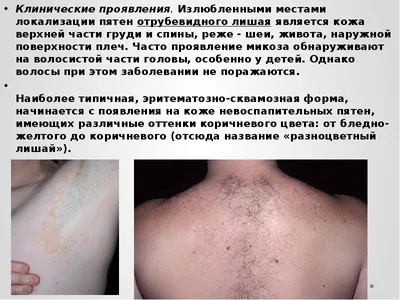 dr_kotlobai - Замечали подобные пятна у себя или у окружающих?😨 Это  разноцветный или отрубевидный лишай🎨. Но не пугайтесь страшного названия,  заболевание не заразно. Эти пятна возникают в результате нарушения в  соотношении микрофлоры