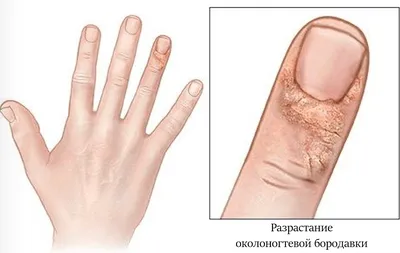 🔻Околоногтевая бородавка Один из... - LV_doctor_cosmetology | Facebook