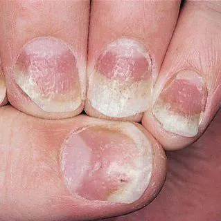 Дистрофия ногтя, или ониходистрофия это изменение формы, размера и  структуры ногтевой пластины. Она включает также изменения ложа ногтя и… |  Instagram