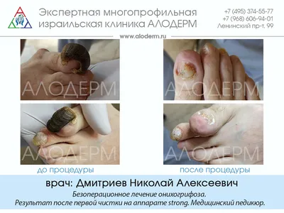 Лечение ногтей СПб. Лечение болезней ногтей в Nail Clinic