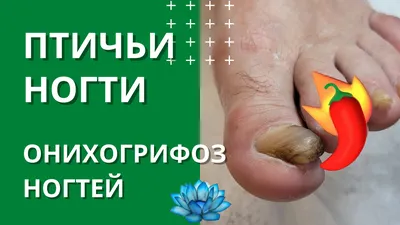 Nail_podolog - При некоторых заболеваниях ногтей пластины так  деформируются, что мешают нормально ходить и сильно снижают качество жизни.  Одна из таких болезней — онихогрифоз. Это состояние с тяжелым изменением  ногтевой пластины, когда