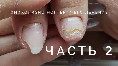 ⭐ Эффективное лечение онихолизиса ногтей - Отзывы на сайте - podonails.com