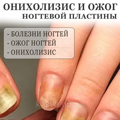 Онихолизис. Что делать? | imkosmetik журнал