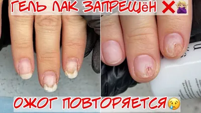 Онихолизис. Протезирование