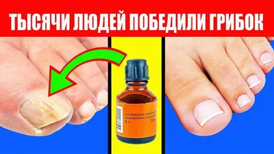 Как Вылечить Грибок на Ногтях Ног? NormaDerm от Грибка Ногтей — Купить на  BIGL.UA ᐉ Удобная Доставка (1254699557)