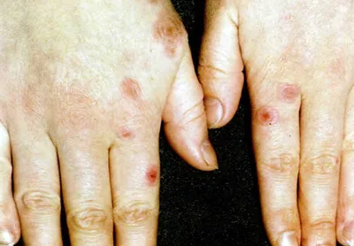 Будьте внимательны: ТОП-7 самых неочевидных признаков рака кожи