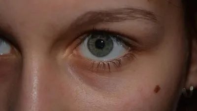 Рак глаза: Онколог Черемушкин назвал редкую и опасную разновидность рака