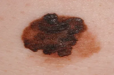 Плоскоклеточный рак кожи: что это? | LazerJazz | Дзен