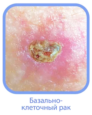 Меланома Юнит Москва - Сегодня предлагаем поговорить об еще одном типе рака  кожа - базалиоме. Базально-клеточный рак или базалиома - один из самых  распространенных типов рака кожи, но одновременно и самый безопасный.