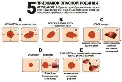 Родинки на голове: можно ли удалять? | МЦ Лазерсвiт