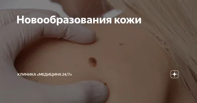 Диагностика рака кожи в Киеве - стоимость лечения | Brennerclinic