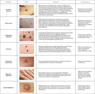 Родинки на теле: виды, какие опасны, профилактика меланомы