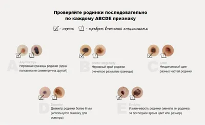 Невус: виды, причины, симптомы, диагностика