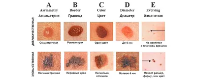 Косметолог развенчивает мифы о родинках — когда их можно и нельзя удалять