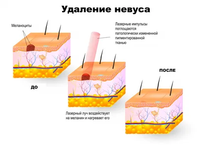 Центр ПЛАСТЭС - удаление родинок