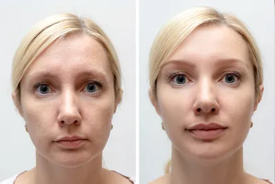 Lip Lift - операция по субназальному поднятию губы