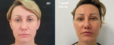 Булхорн в СПб: цена на хейлопластику, операция по пластике верхней губы