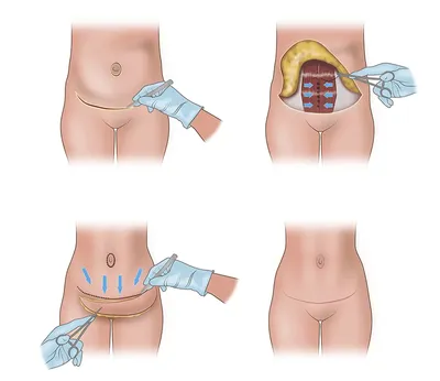 Абдоминопластика (подтяжка живота) - цена в Минске