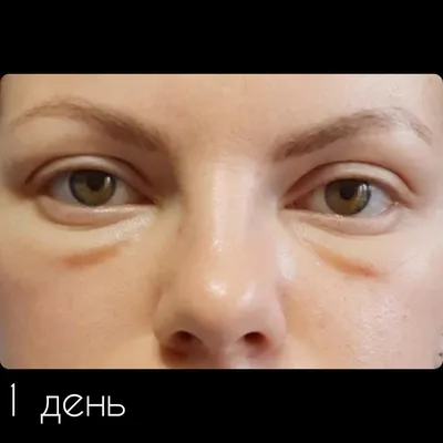 Косметическая хирургия глаз - Эстетическая коррекция нижнего и верхнего  века - доктор Гунцель Озтурк - YouTube
