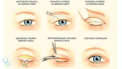 Бефаропластика лица и глаз: как убрать нависшее веко и мешки под глазами