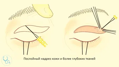 Круговая блефаропластика, фото через 4 месяца — Пластический хирург Сергей  Дерновой: консультация в Москве