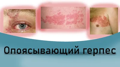 Розовый лишай: симптомы, причины, лечение (ФОТО)