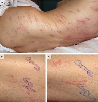 Врачи описали редкую инфекцию, в ходе которой под кожей всего тела пациента  извивались черви — Ferra.ru
