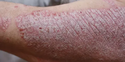 Опоясывающий лишай Versicolor или Pityriasis альбы в шею юго-восточной азии  человека Стоковое Фото - изображение насчитывающей заболевание, наведено:  196972444