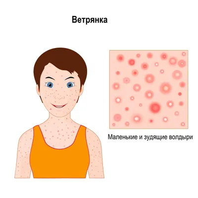 4 симптома себорейного дерматита